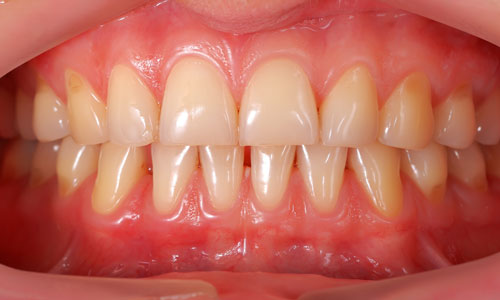 A photo of a dental patient's teeth and gums