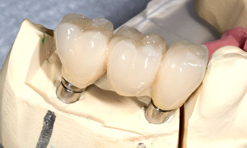 A model of a dental implant bridge