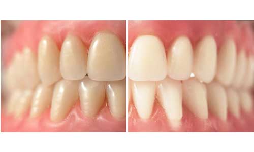 before and after teeth whitening in charlotte