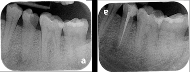 X-rays of teeth before and after a root canal procedure