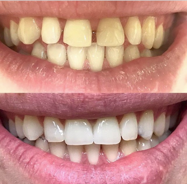 before and after cosmetic dental care in charlotte