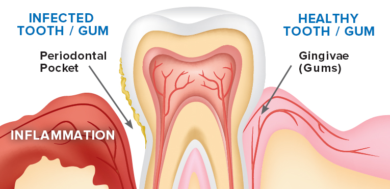 The Downhill Dangers of Gum Disease