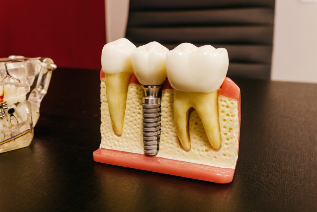 Top 6 Benefits of Dental Implants