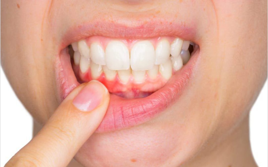 Periodontal disease – symptoms, treatment, and prevention