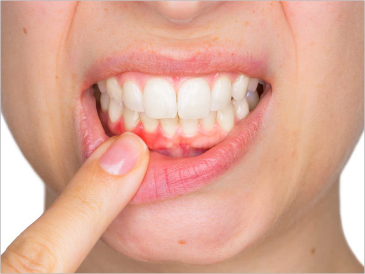 Periodontal disease causes and treatment