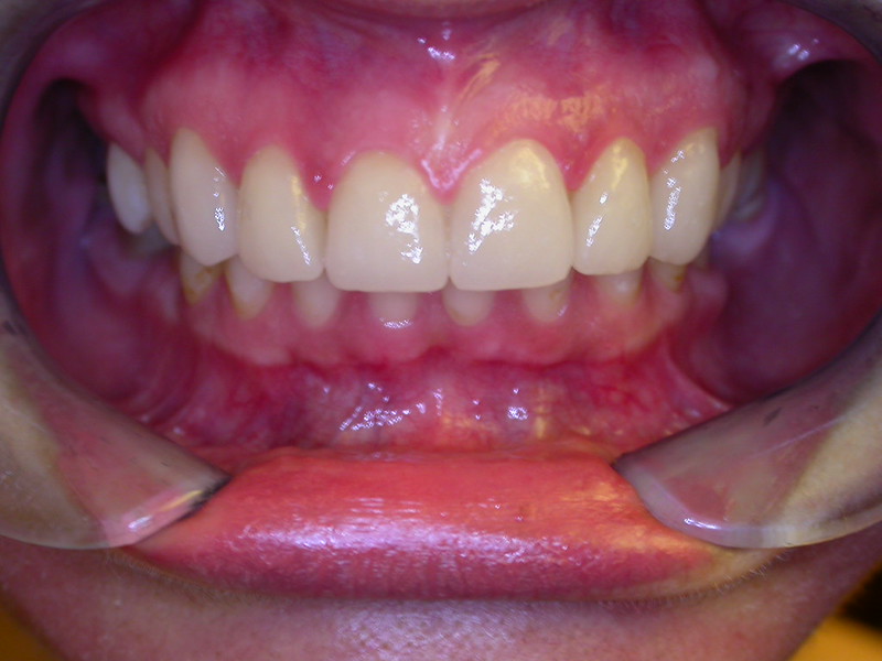 Can I get Veneers if My Natural Teeth are Crooked?