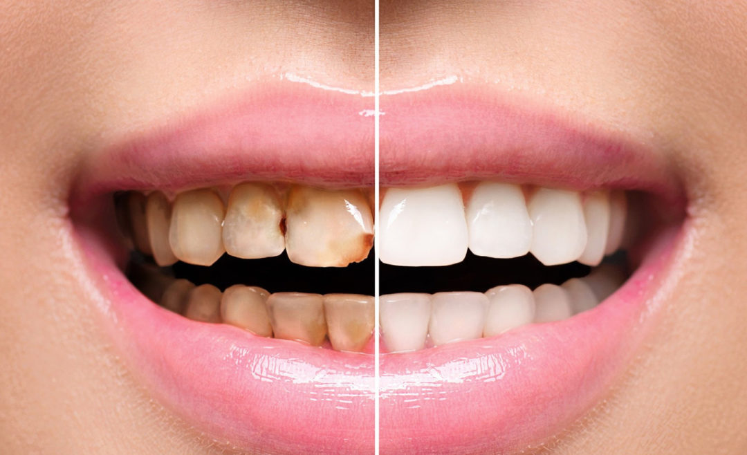 Top Reasons to Consider a Full Mouth Reconstruction in Charlotte, NC
